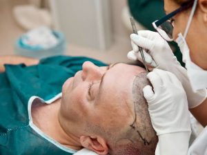 The Significance Of Donor Hair Quality For Effective Hair Transplant Operations